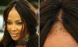 La máscara para los cabellos con dimeksidom para el crecimiento de los cabello de la foto antes y de