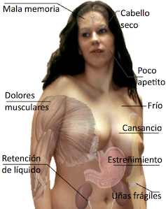 síntomas de Hipotiroidismo